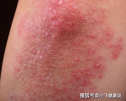 牛皮癬會傳染么 專家說 對于銀屑病,你們的 誤解 實在太深