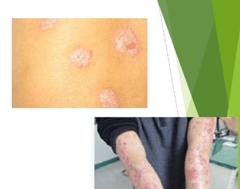 牛皮癬基本常識