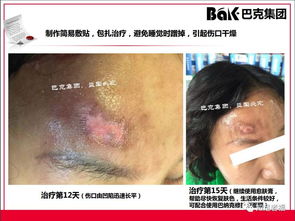 一切皮膚病及外傷的克星,傳統文化義工的事業 巴克產品介紹