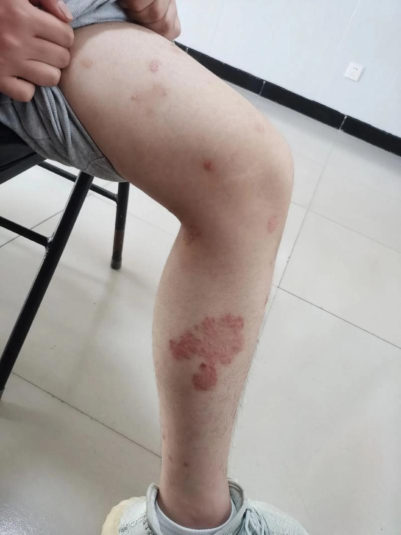 尋常性銀屑病(牛皮癬)