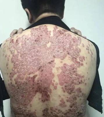 【科普】“頑疾”銀屑病會傳染嗎?如何治療?市一醫院皮膚科專家帶你走進治療新時代