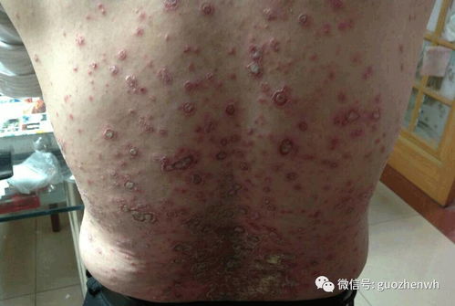 國珍產品調理好了老爸26年牛皮癬,食道靜脈曲張等疾病,感恩國珍