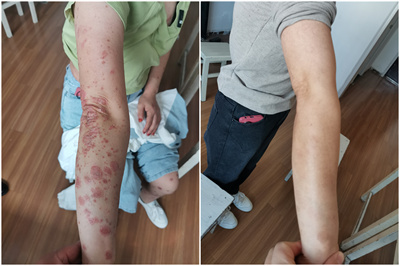 牛皮癬##銀屑病# 根治銀屑癬評論區(qū)聯(lián)系,銀屑病是一種慢性,復發(fā)性