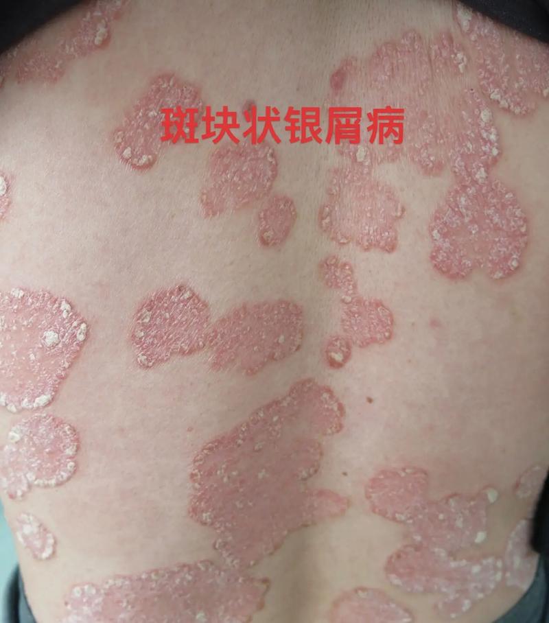 銀屑病,俗稱牛皮癬,為皮膚科常見病.但有的患者不熟悉,不了解