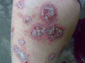 經(jīng)典圖片 銀屑病