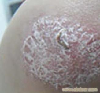 唐山牛皮癬就醫(yī)需要注意的四項原則_唐山牛皮癬就醫(yī)需要注意的四項原則高清大圖_唐山牛皮癬就醫(yī)需要注意的四項原則高清圖片_一比多產(chǎn)品庫