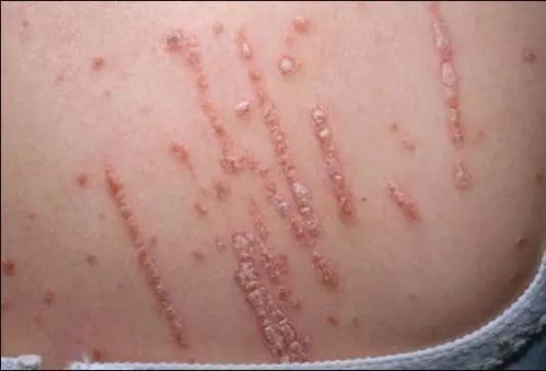 銀屑病是哪些原因造成的呢 哪些因素會造成銀屑病惡化呢