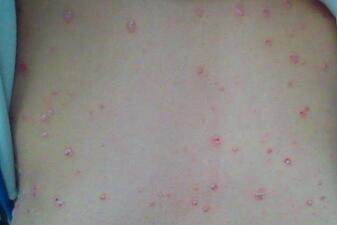 紅皮型牛皮癬初期會(huì)有哪些具體表現(xiàn)