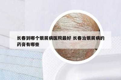 長(zhǎng)春到哪個(gè)銀屑病醫(yī)院最好 長(zhǎng)春治銀屑病的藥膏有哪些