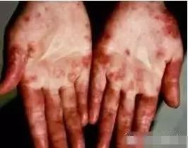 食用菌產(chǎn)品的神奇見(jiàn)證 白癲風(fēng) 牛皮癬 紅斑狼瘡