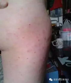 牛皮癬的克星 講述一位嚴(yán)重牛皮癬康復(fù)過(guò)程