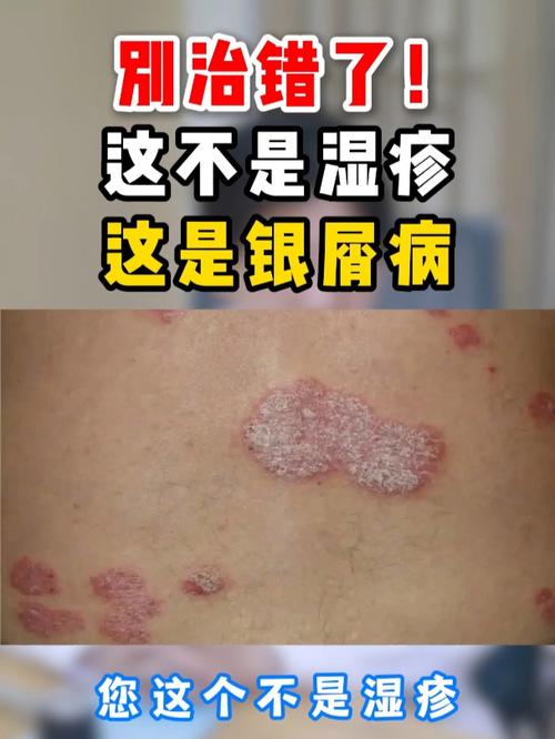 別治錯(cuò)了!這不是濕疹 這是銀屑病