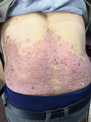 銀屑病牛皮癬是“辛苦”出來(lái)的