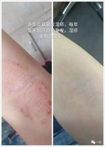 口碑 明星產(chǎn)品 蟾酥濕疹膏