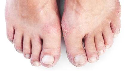 銀屑病的臨床表現及類型