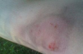 沈陽牛皮癬醫院該如何選擇