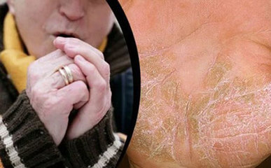 十大銀屑病發病原因|引起銀屑病誘因和治療方法