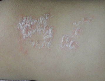 醋泡大蒜能治牛皮癬嗎？科學解讀與理性建議