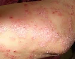 血虛型牛皮癬的成因、癥狀與中醫治療調理