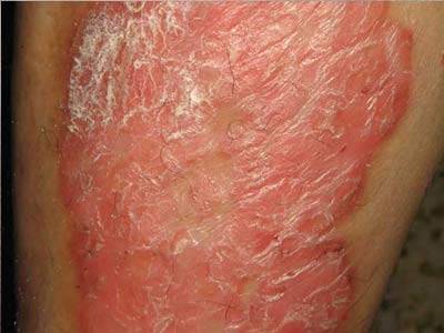 銀屑病（牛皮癬）的常見癥狀