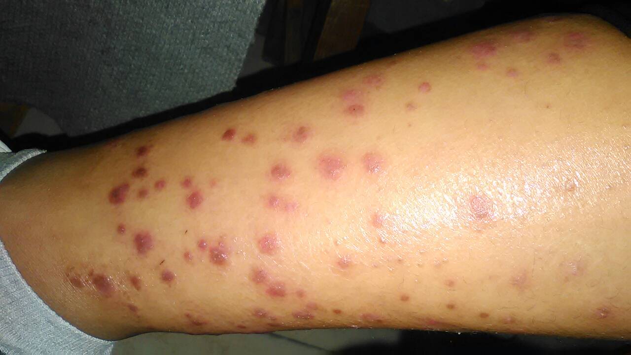 銀屑病（牛皮癬）的綜合治療與穴位按摩輔助療法