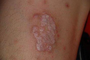 老偏方治療牛皮癬（銀屑病） 傳統智慧的探索與考量