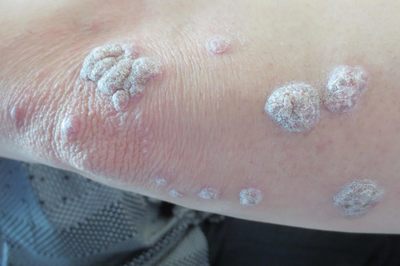 牛皮癬早期癥狀詳解 識別早期信號，科學應對