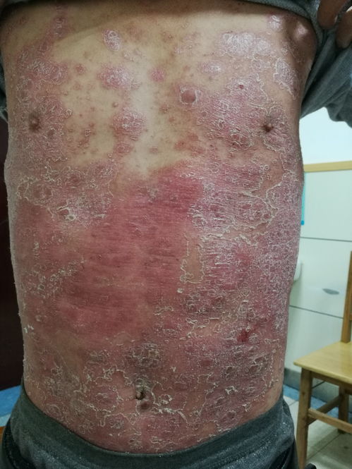 銀屑?。ㄅＦぐ_）治療病例分享 從困擾到緩解的歷程