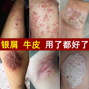 牛皮成人外用軟膏 非激素止癢良方，專治銀屑病與各種癬癥