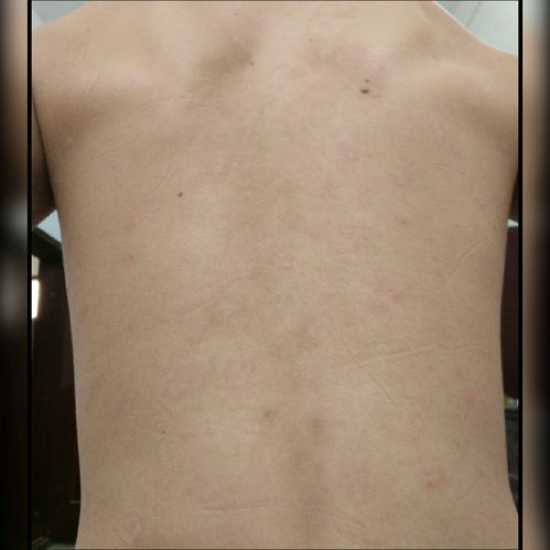 精神因素與牛皮癬（銀屑?。┑年P聯及應對策略