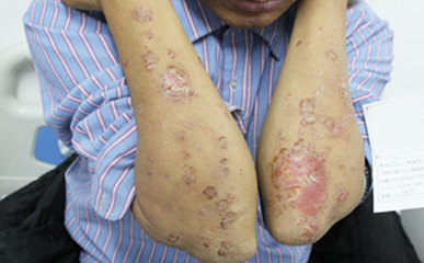 銀屑病春發高峰將至，防治要有效及時