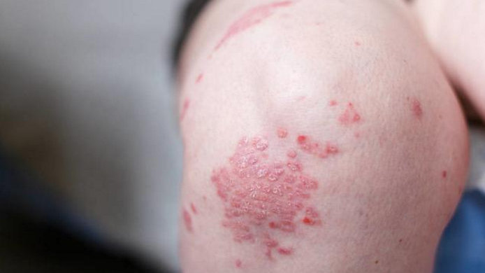 關于銀屑?。ㄅＦぐ_）的3個真相！破除誤解，科學治療