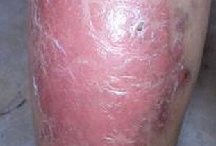 牛皮癬的西醫診斷方法